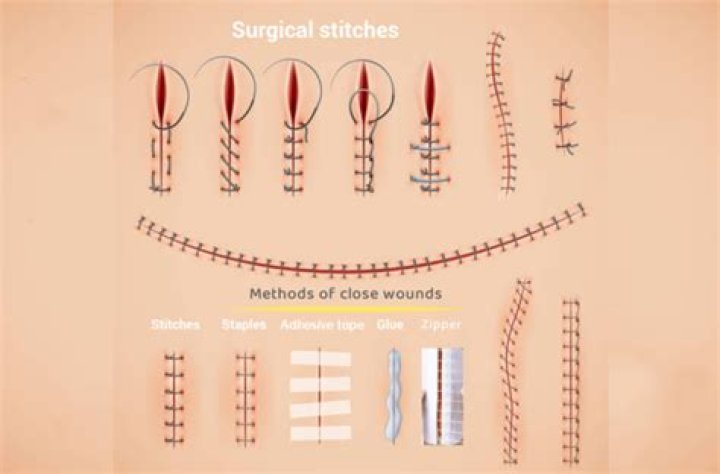Can ants be used as stitches?