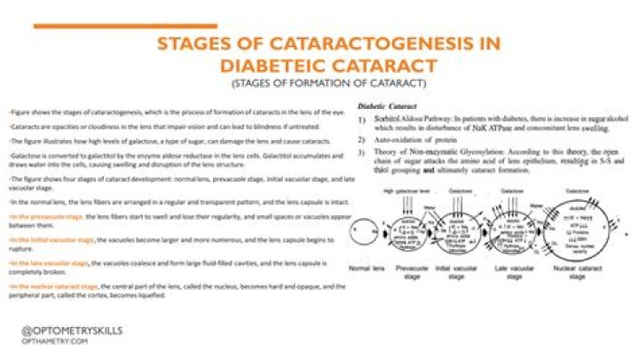 Can diabetes cause cataracts?