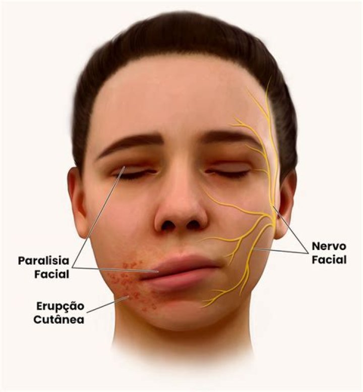 Can shingles affect the trigeminal nerve?