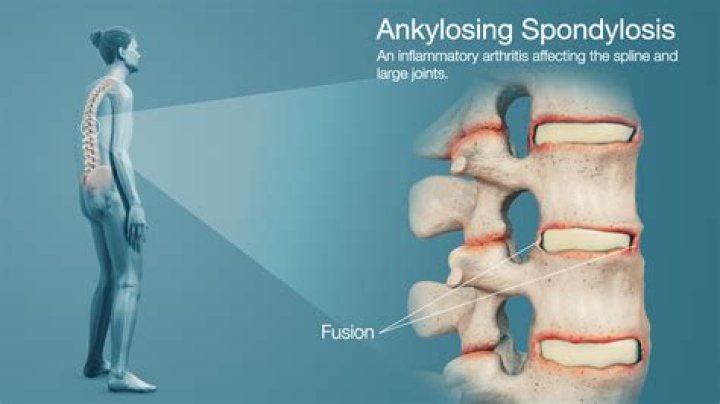 Does HUMIRA work for ankylosing spondylitis?