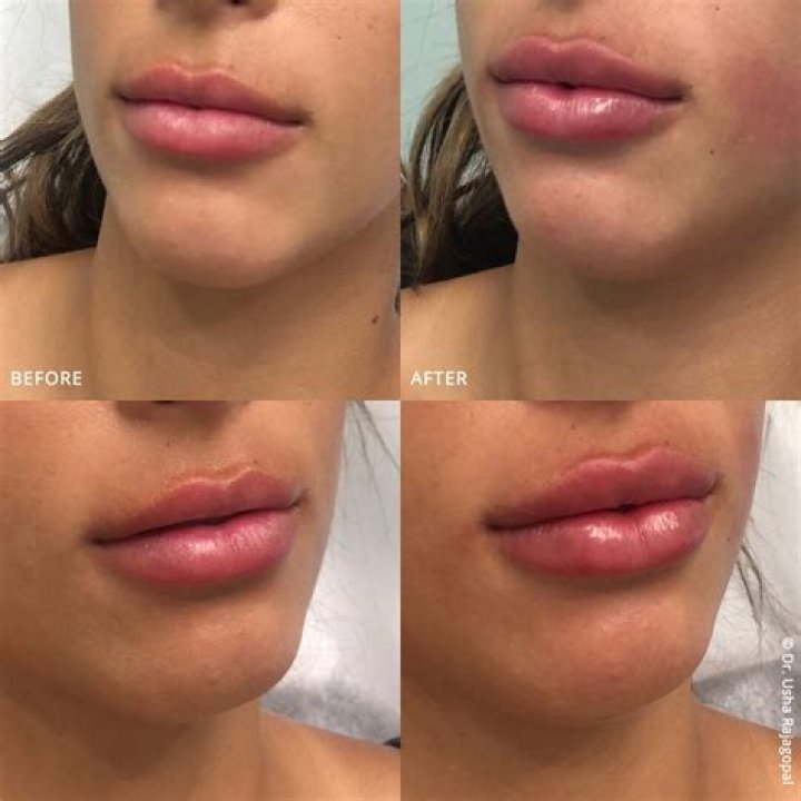 Does lip kiss increase weight?