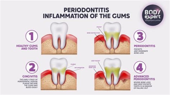 How common is chronic periodontitis