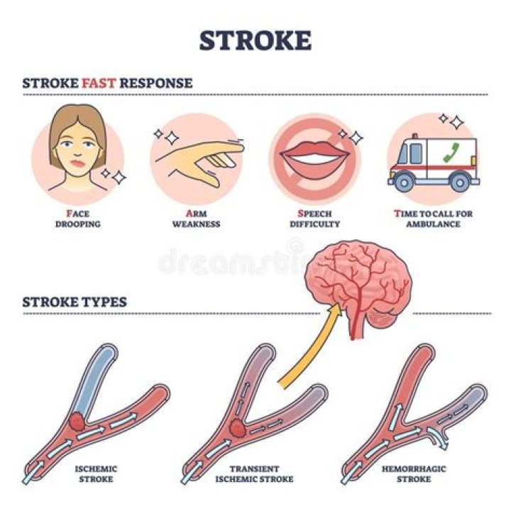 How do you explain a stroke to a patient?