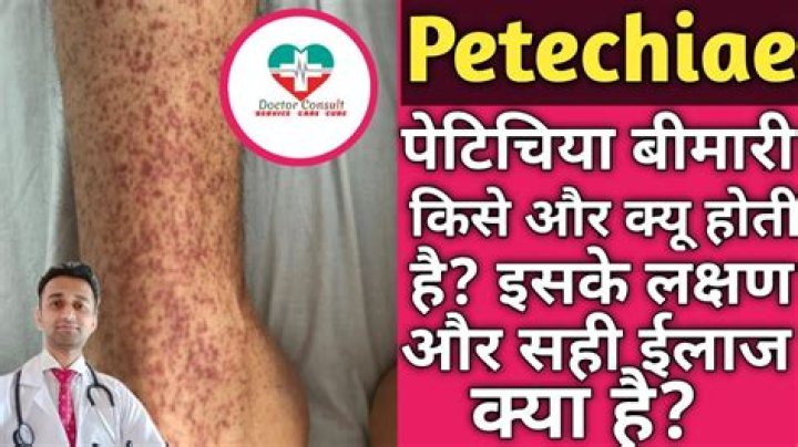 How do you get rid of petechiae