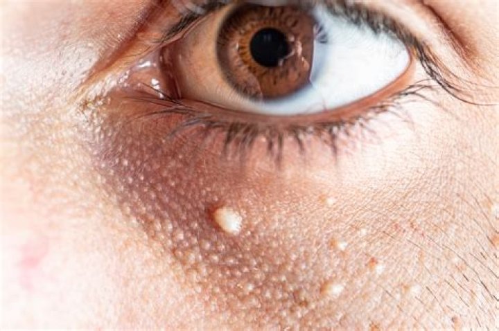 How do you remove milia seeds?