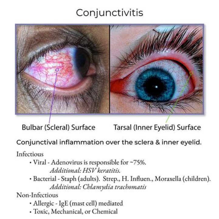 How is large papillary conjunctivitis treated?