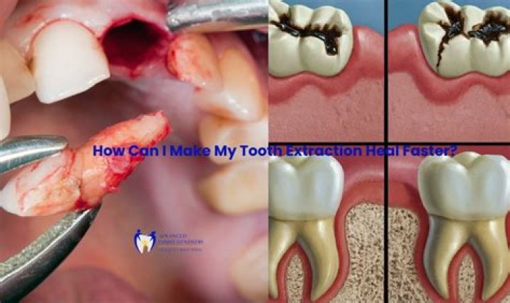 How long after tooth extraction can I have a bridge?