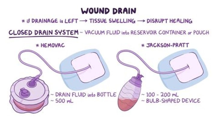 How long do you keep a JP drain in place?