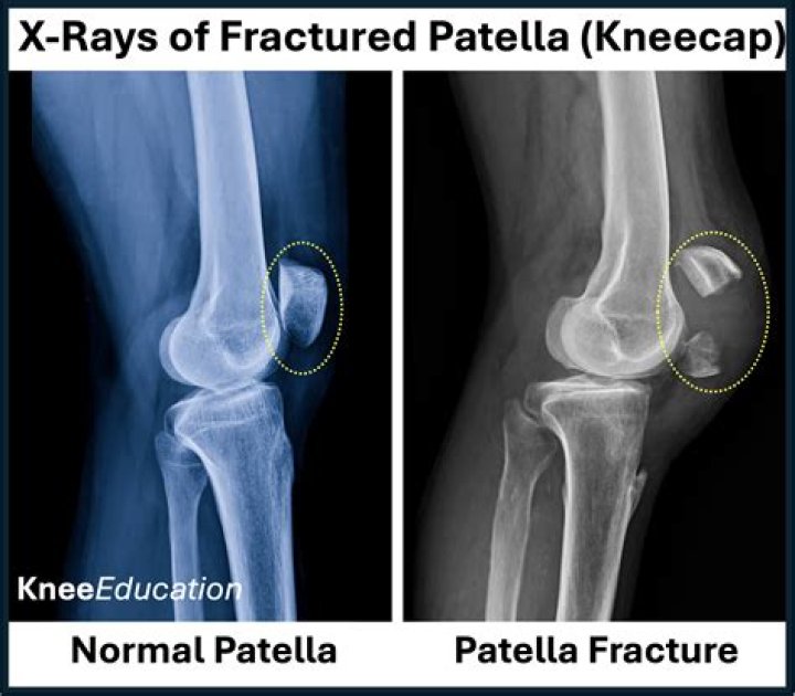 How long does a non displaced knee fracture take to heal?