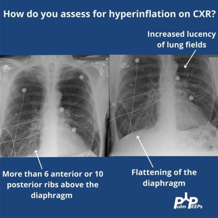 How many ribs CXR hyperinflation?