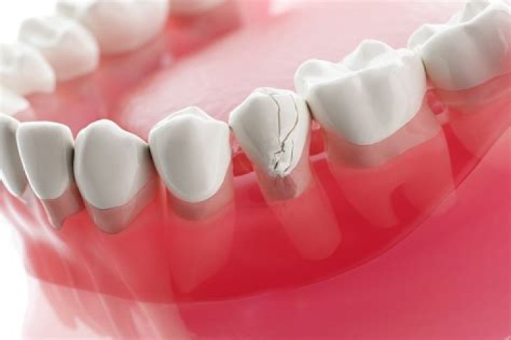 Is a broken tooth an emergency?