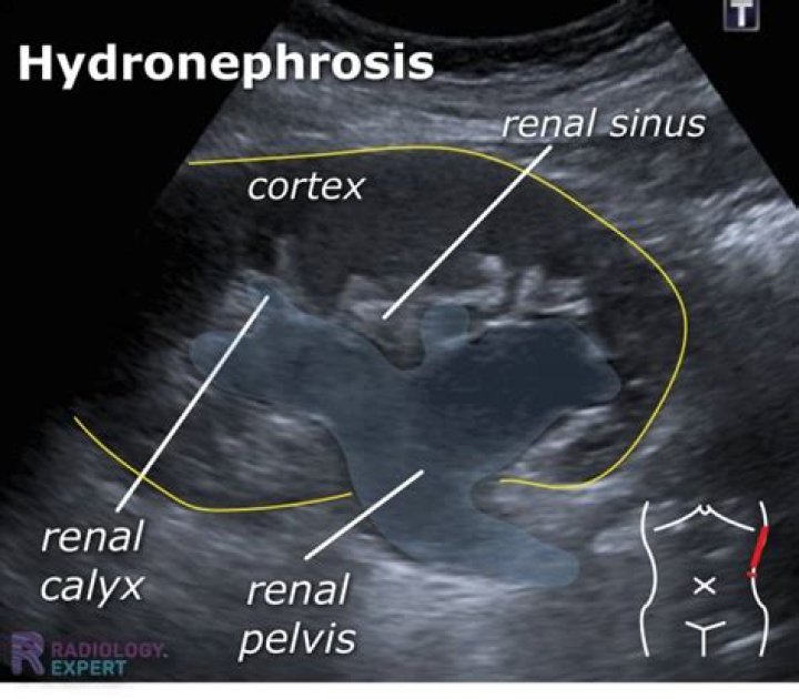 Is Extrarenal pelvis dangerous? | ContextResponse.com