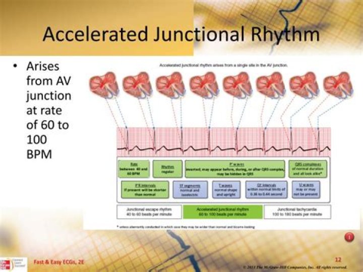 What causes accelerated junctional rhythm?