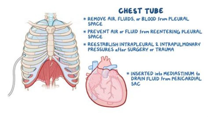 What does pneumomediastinum feel like?