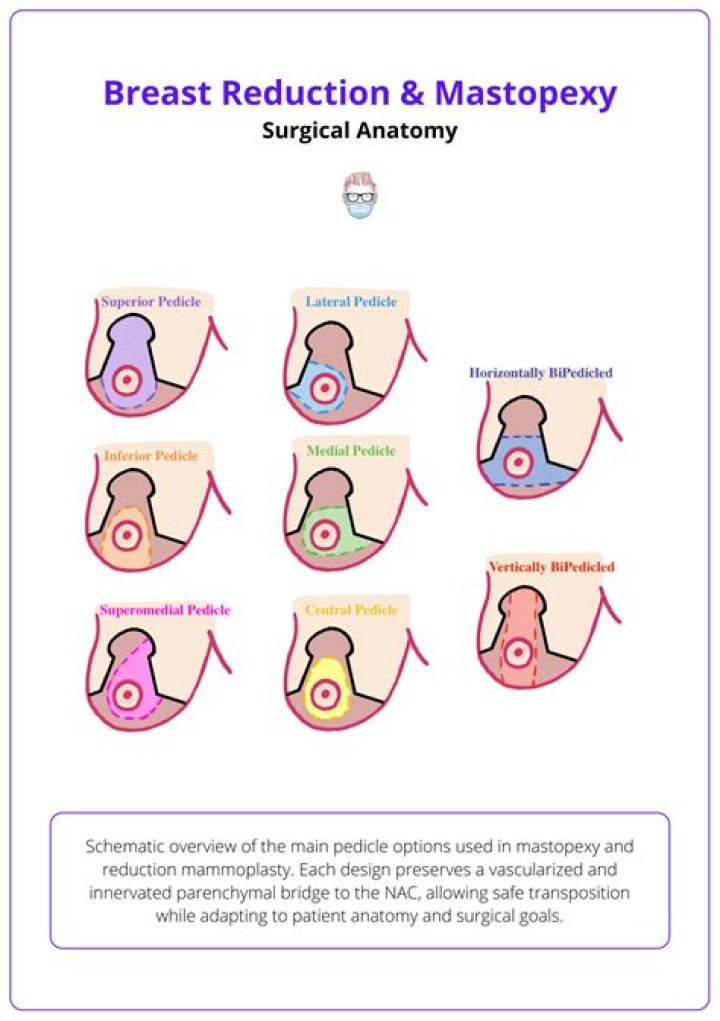 What is a wise pattern mastopexy