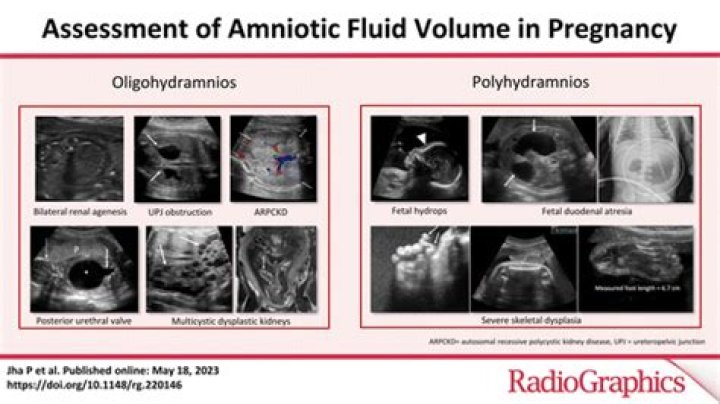 What is Ferning amniotic fluid?