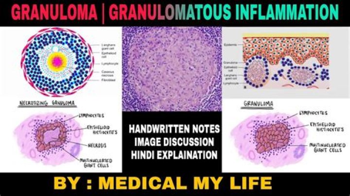 What is granulomatous of the spleen?