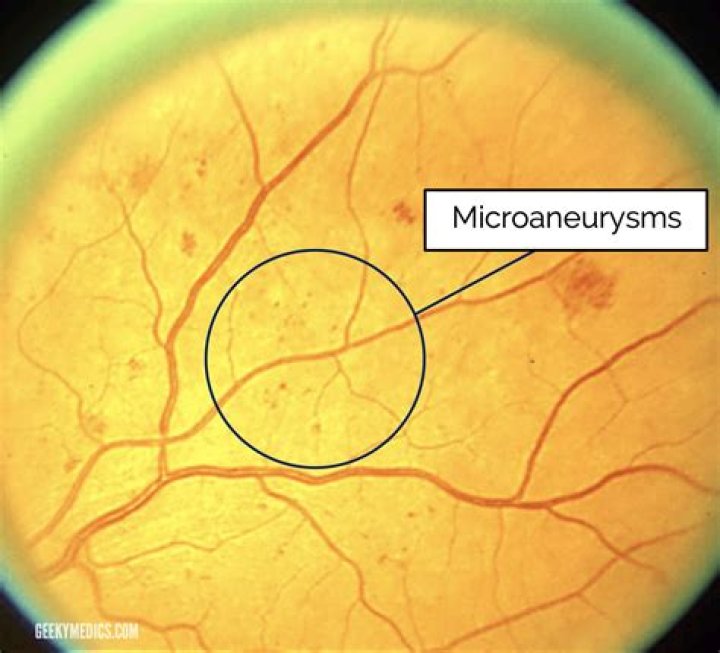 What is Microaneurysm in the eyes?