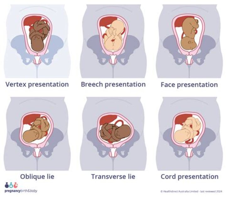 What is oblique presentation in pregnancy?