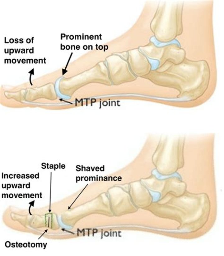 What is PTP and MTP?