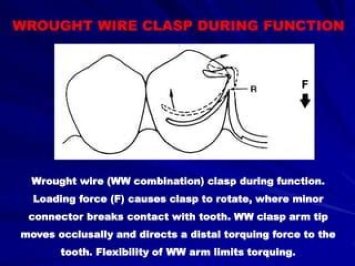What is wrought wire clasp?