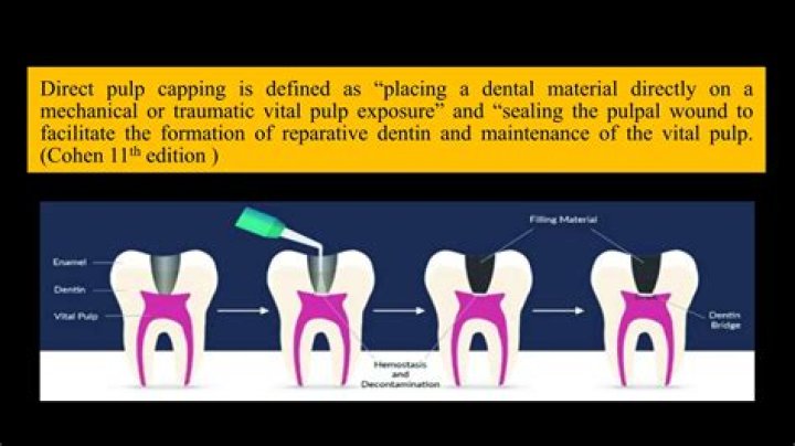 What materials are used for pulp capping?