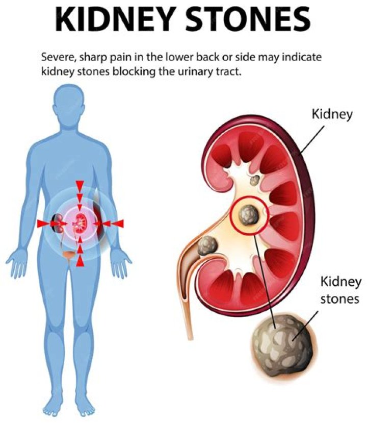 What Stone helps with inflammation?