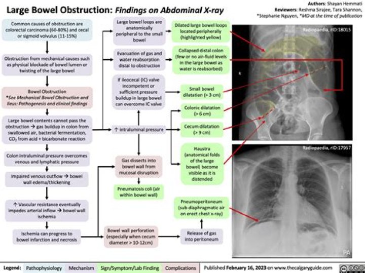 Will abdominal xray show bowel obstruction